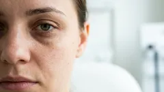 Jak odstranit tmavé kruhy pod očima bez drahých krémů – 7 jednoduchých tipů od odborníka