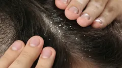 Šampon není potřeba: rozlučte se s lupy díky koření, které má doma každý